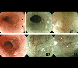 拡大内視鏡検査/NBI併用拡大内視鏡(早期がん診断) | 治療・手術から