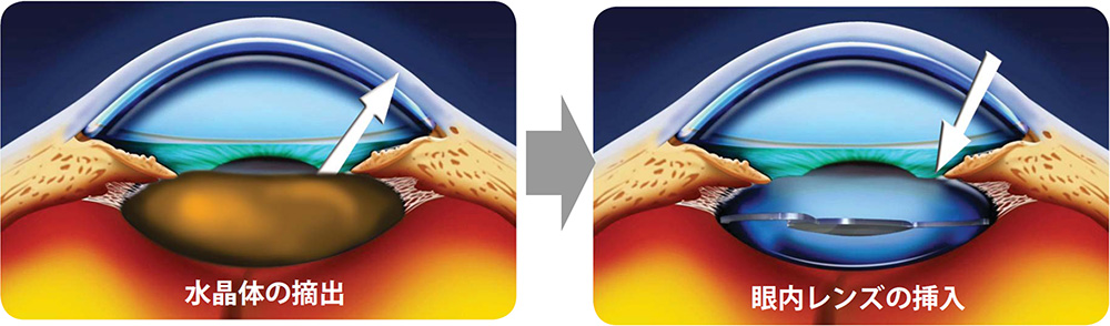 多焦点眼内レンズ - 福山市の眼科 中山眼科