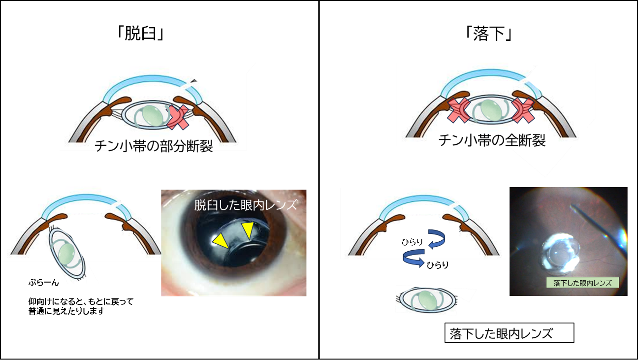 眼内レンズ固定術｜平塚市松風町で目のお悩みなら－松風たかぎ眼科