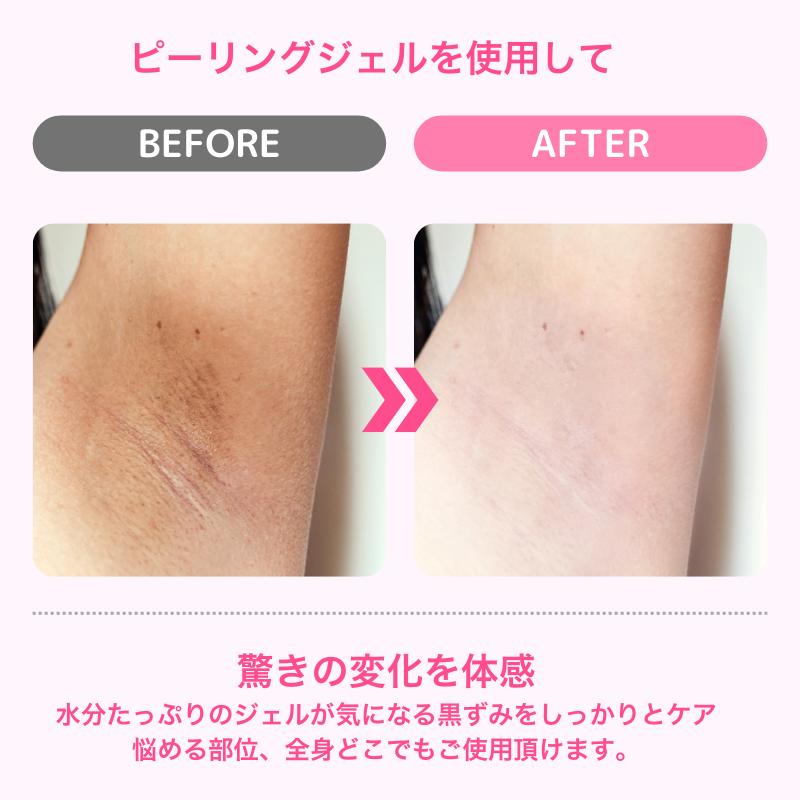 楽天市場】【黒ずみケア☆楽天1位】 デリケートゾーン 黒ずみ VIO 美白