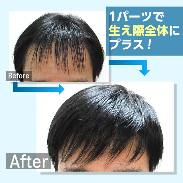 楽天市場】生え際全体にプラス！増毛くんシリーズはえぎわくん【L