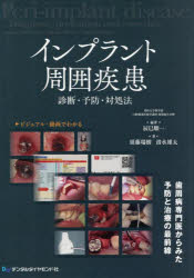 楽天市場】インプラントトラブルの対応策と予防策の通販