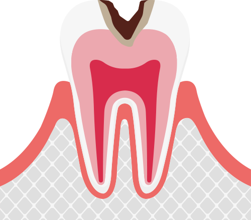 虫歯の特徴・治療方法 | 梅田アップル歯科