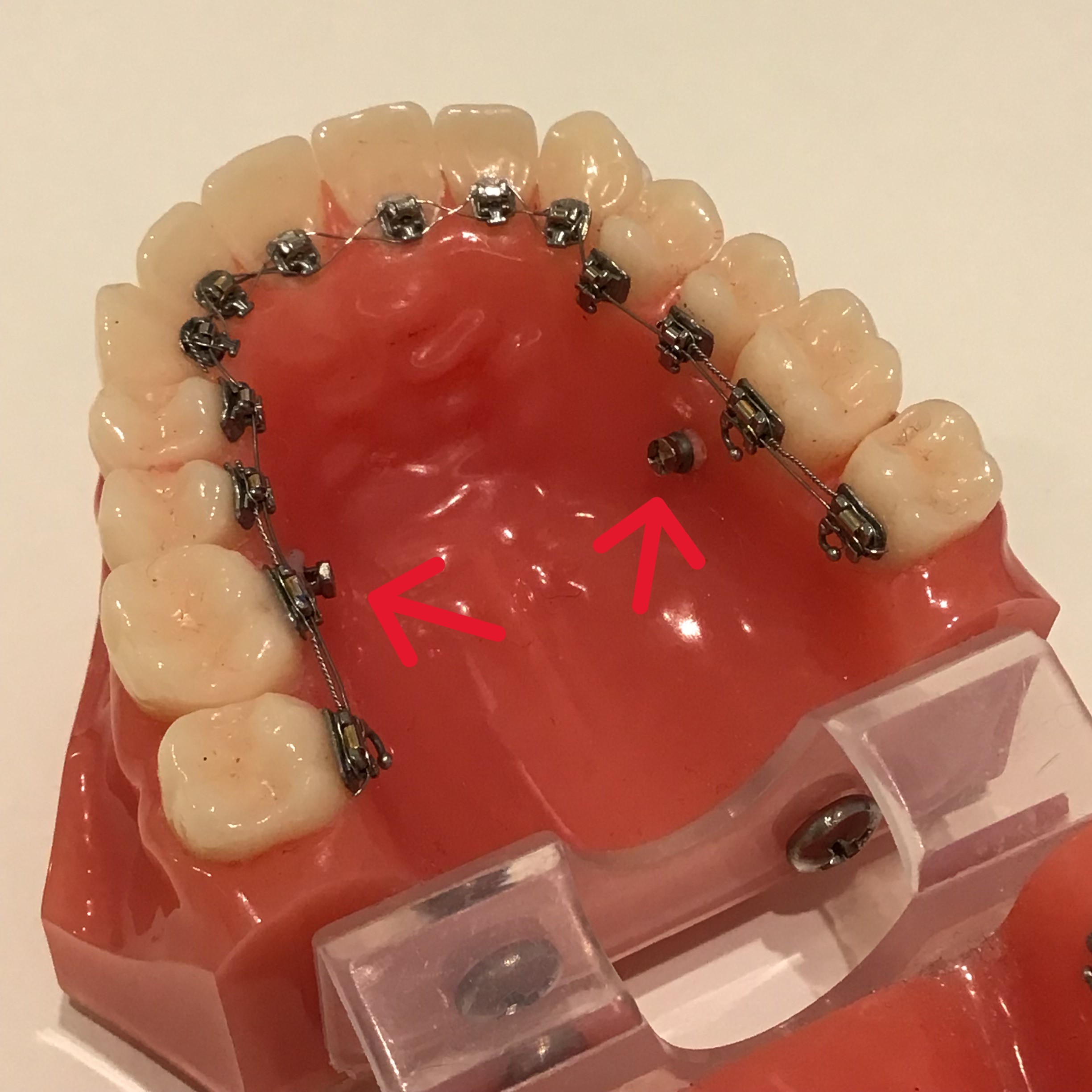 アンカースクリューを使った歯科矯正方法とは？ - 【公式】梅田キュア