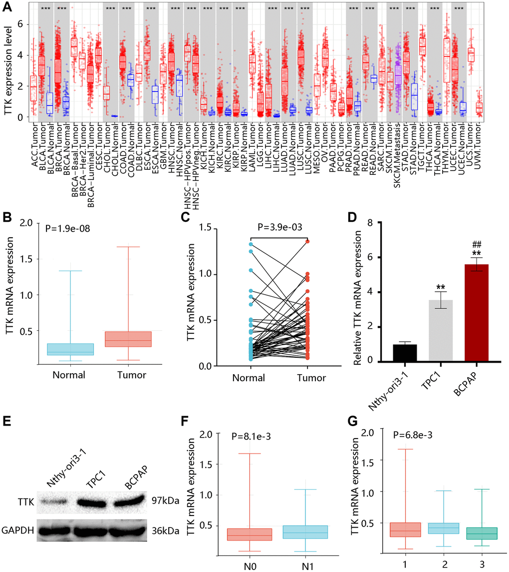 TTK is a potential regulator of tumor progression correlated with