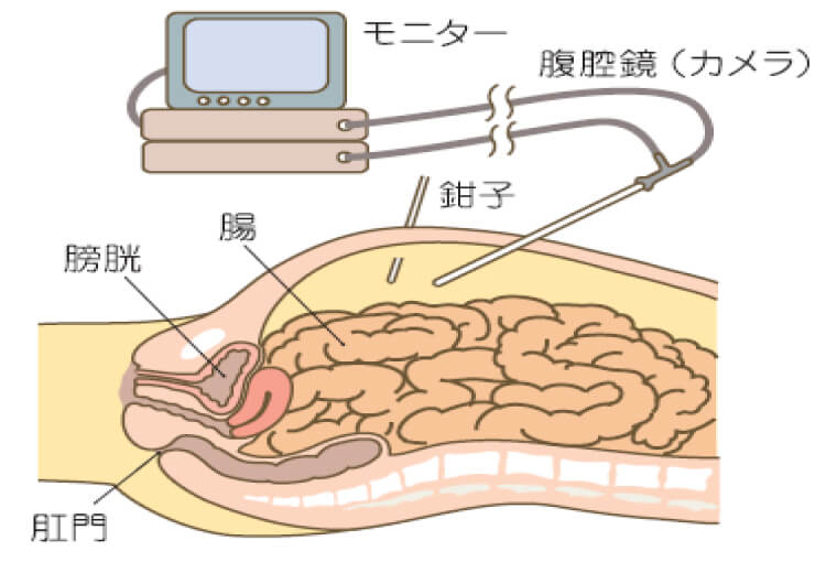 低侵襲手術について - 診療案内 - 愛知医科大学 消化器外科