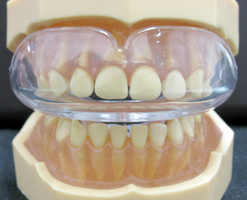 ムーシールド｜さいたま市見沼区の歯医者｜アクア歯科・矯正歯科クリニック