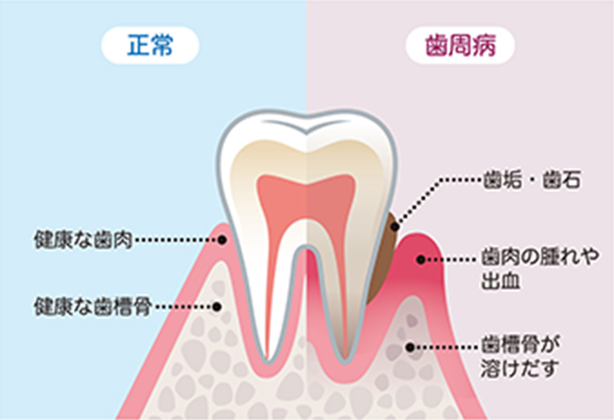 歯周病治療│防府の歯医者 インプラントのクリスタル歯科