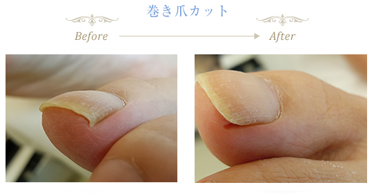 巻き爪補正コース プロ養成コース｜一般社団法人日本フットケア