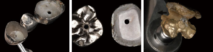 イージークラウンリムーバー｜株式会社フォレスト・ワン 矯正歯科