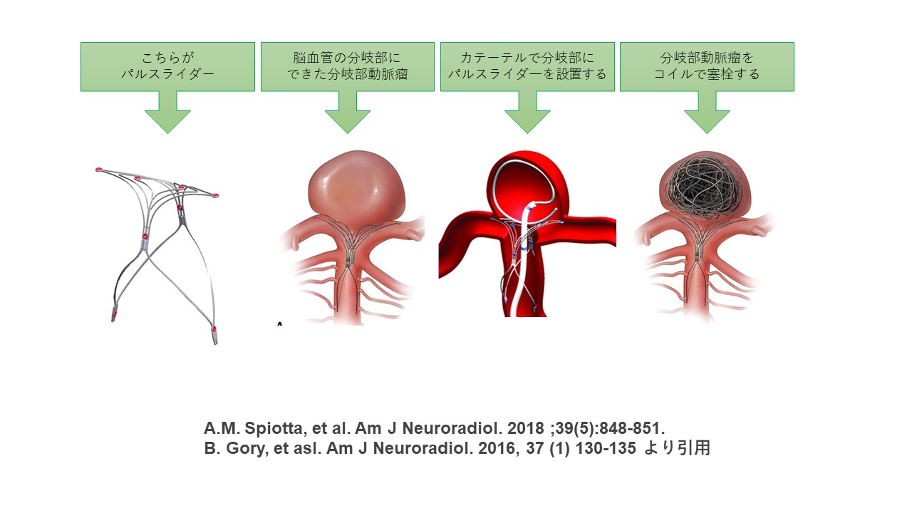 脳動脈瘤治療の最新機器パルスライダーを導入しました – 福井赤十字病院