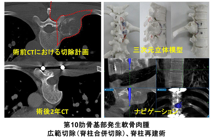 骨・軟部腫瘍紹介｜診療案内｜弘前大学大学院医学研究科 整形外科学講座