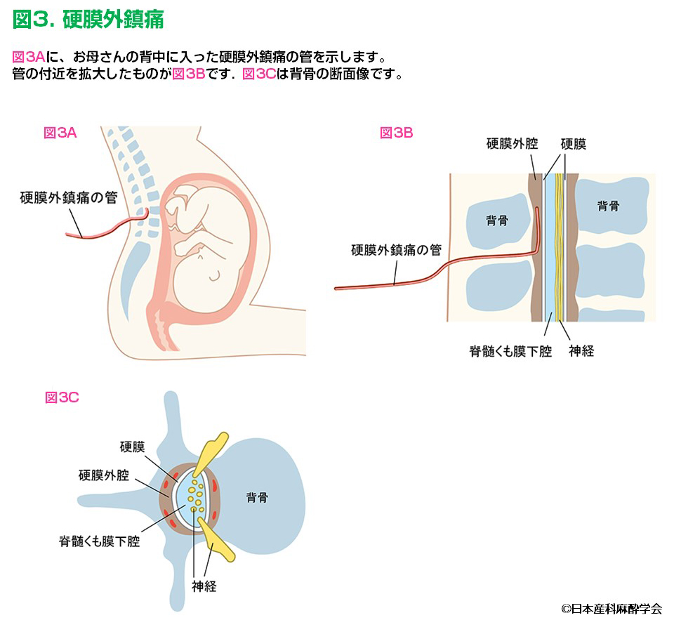 Q4. 硬膜外鎮痛法とはどんな方法ですか？ | 一般社団法人 日本産科麻酔学会