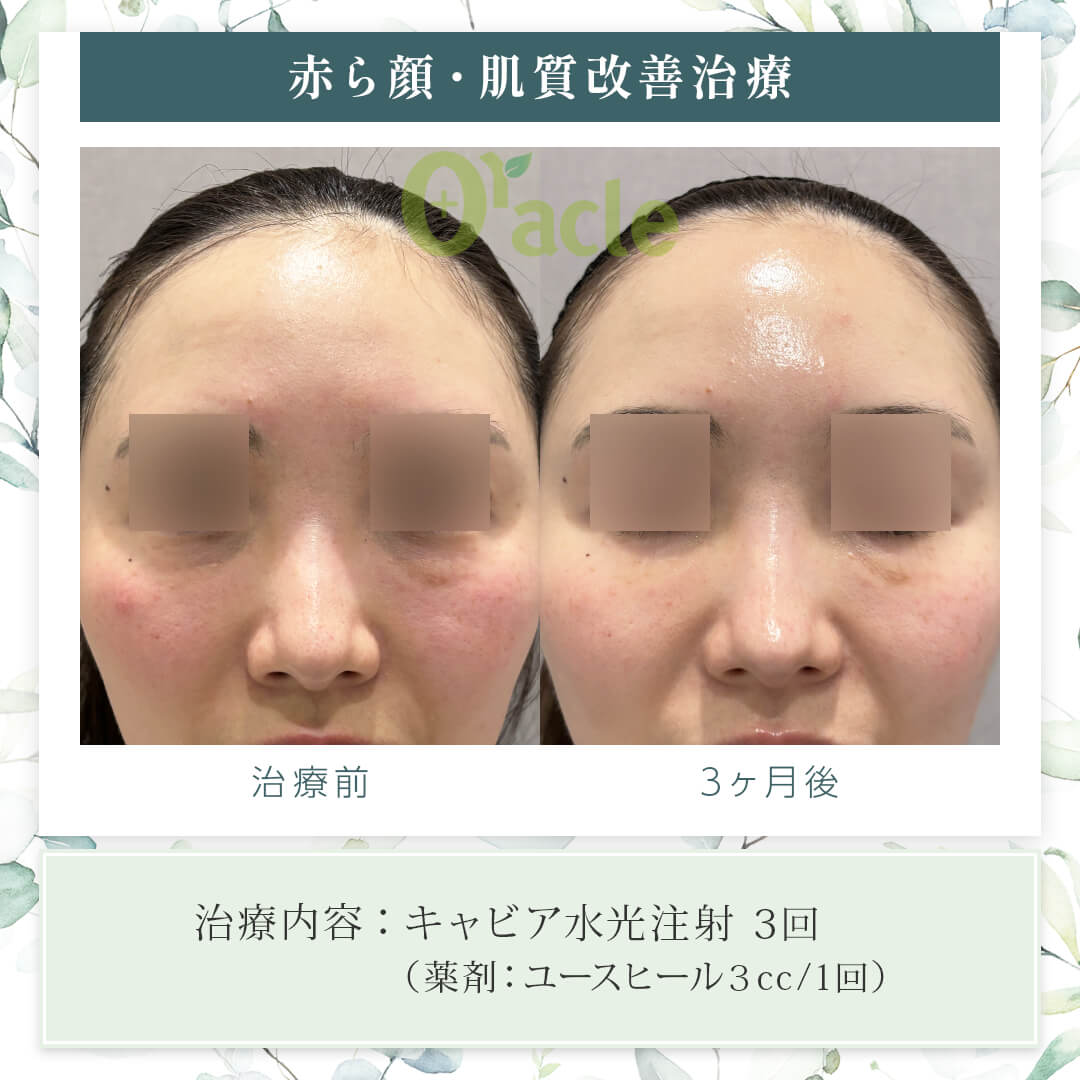 韓国のキャビア注射（ユースヒール）｜【公式】オラクル美容皮膚科