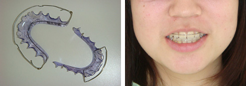 リテーナー（保定装置）の種類について : 渋谷区恵比寿の矯正・矯正