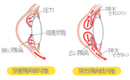 健康の森／緑内障