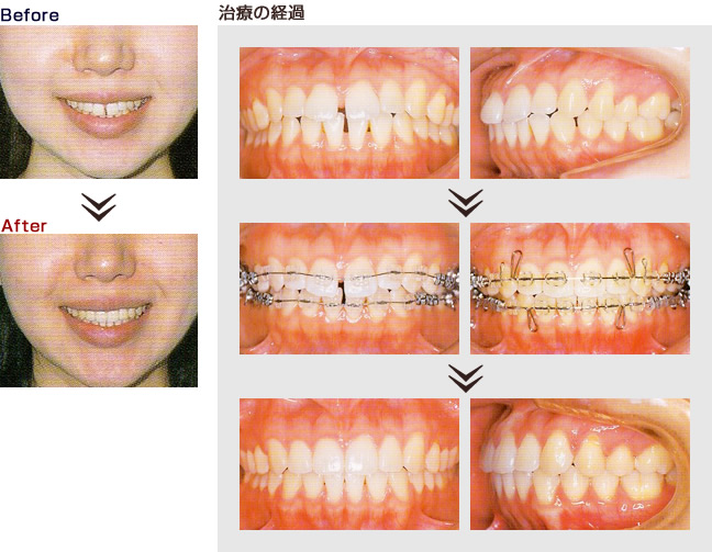 矯正治療 Before → After 不正咬合 | 矯正歯科は西宮市の歯を抜かない