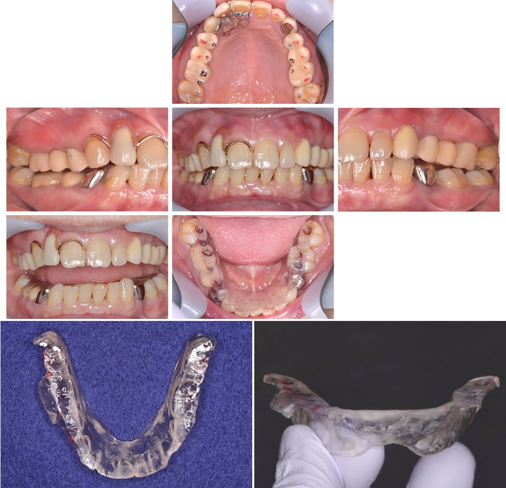 顎関節症の改善・咬み合わせ治療｜巣鴨駅1分の巣鴨S歯科矯正歯科