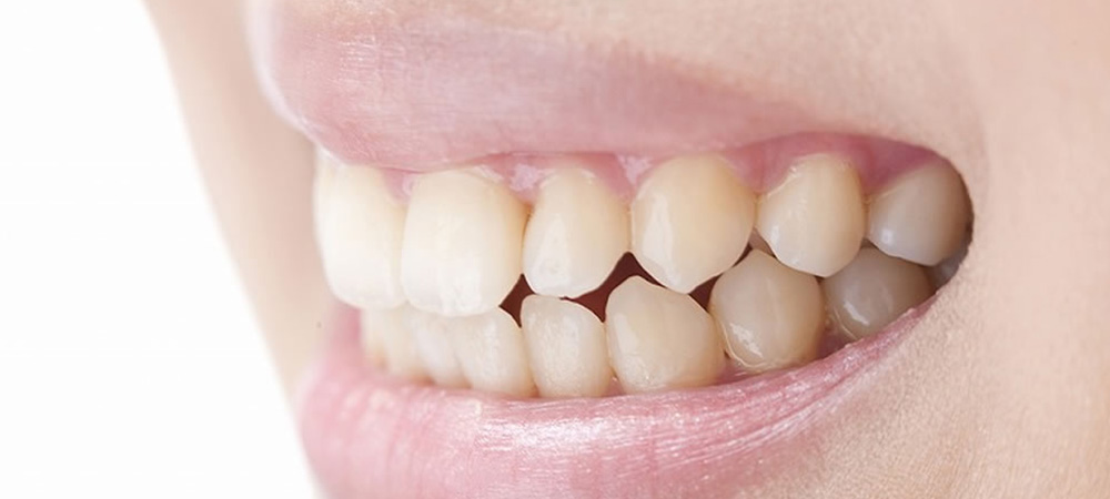 顎関節症の改善・咬み合わせ治療｜巣鴨駅1分の巣鴨S歯科矯正歯科