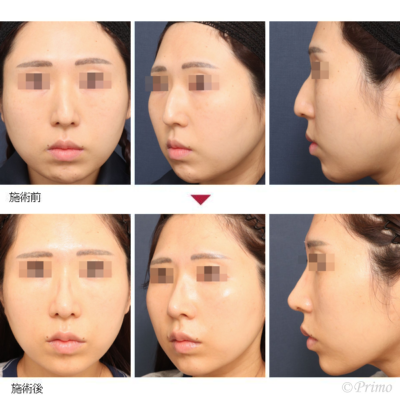 鼻中隔矯正術 症例一覧 | 鼻整形 | プリモ麻布十番クリニック