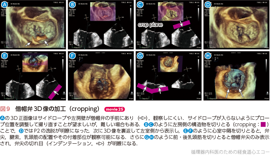 循環器内科医のための経食道心エコー〜基本的な手技から術中・術前の