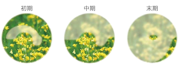 緑内障（開放隅角緑内障）｜やの眼科｜大阪市城東区JR鴫野駅 眼科一般