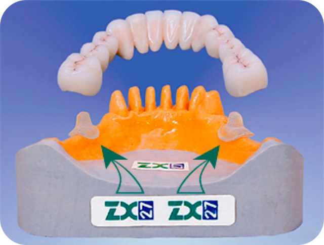 ZX-27 – Non-Surgical Dental Implants Alternative