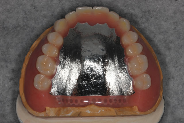 フルデンチャー | 取扱い技工物 | 歯科技工所 株式会社ジェネシス