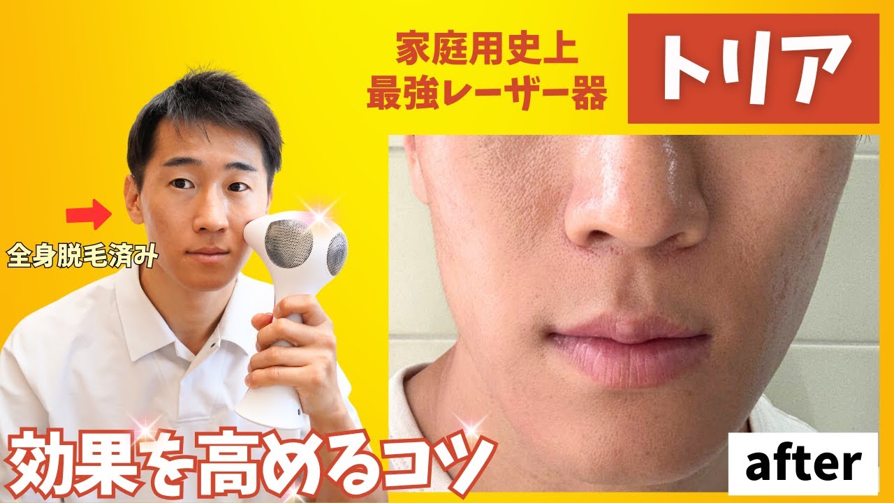 How to use the Tria home laser hair removal device and tips