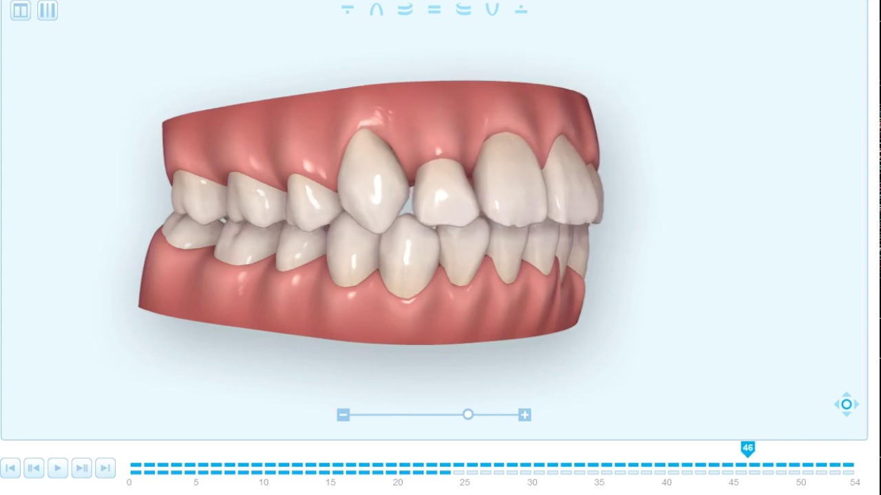3Dデジタル矯正｜目白歯科矯正歯科｜池袋の矯正歯科