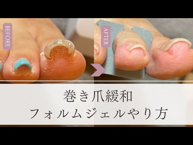 巻き爪緩和 フォルムジェル使用方法動画／塗るだけ／簡単／巻き爪矯正
