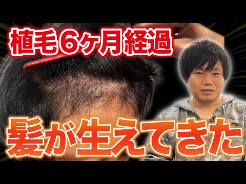 植毛6ヶ月経過】30代メンズが薄毛の辛い時期を乗り越えて笑顔を