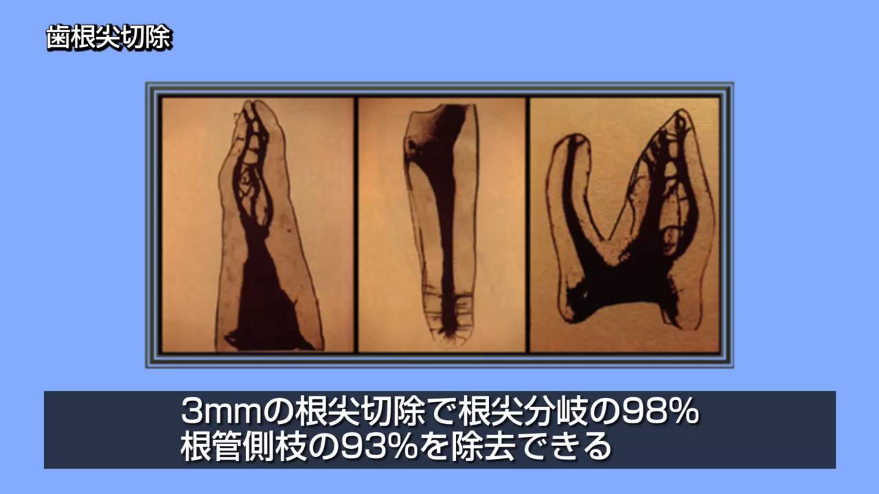 歯内療法先進技能習得教材実習項目：会員向け資料：日本歯内療法学会