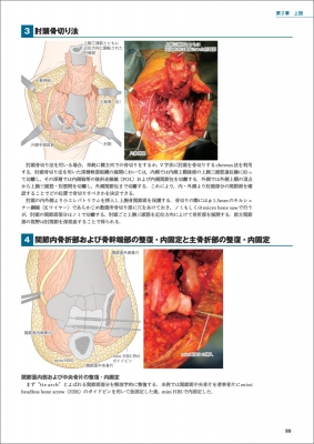 骨折治療 手術アプローチがよくわかる髄内釘・プレート固定 : 渡部欣忍