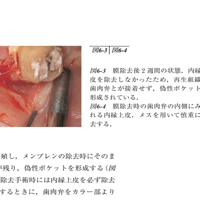 コンセプトを持った予知性の高い歯周外科処置