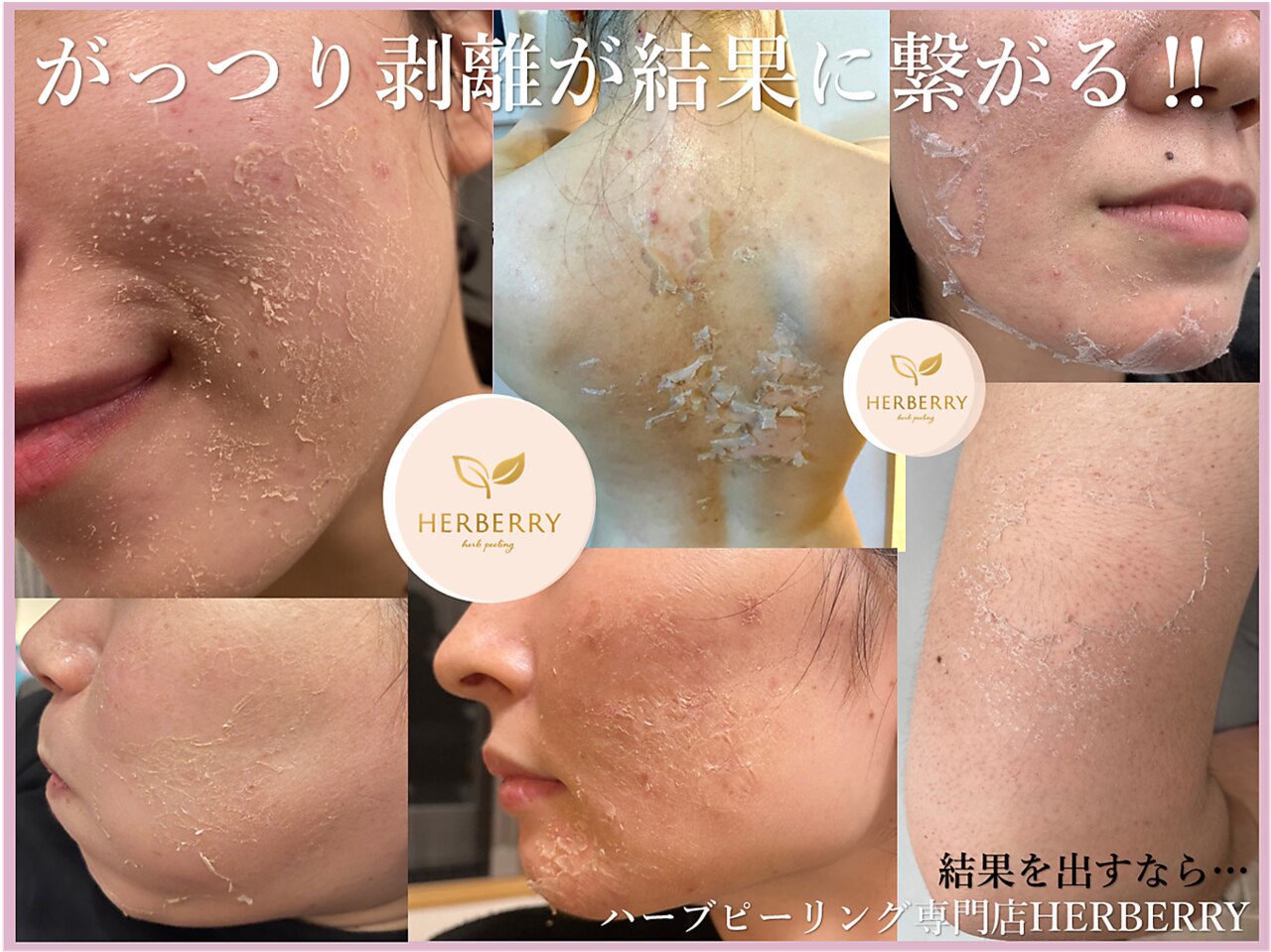 あいうえお様限定】剥離ありハーブピーリング10回分 あいうえお様限定