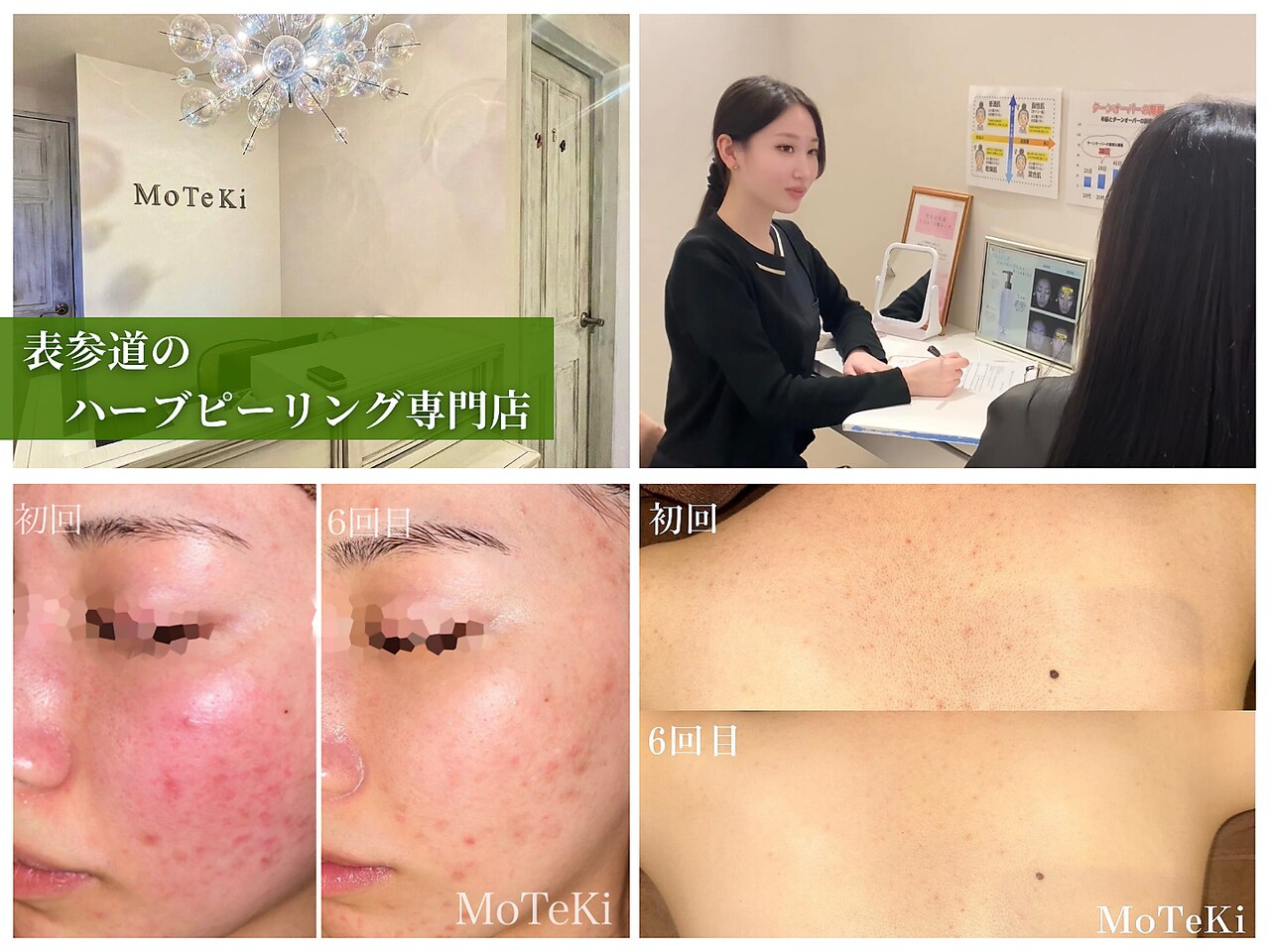ハーブピーリング 剥離 あり 東京に関するエステサロン 美肌ケアサロン