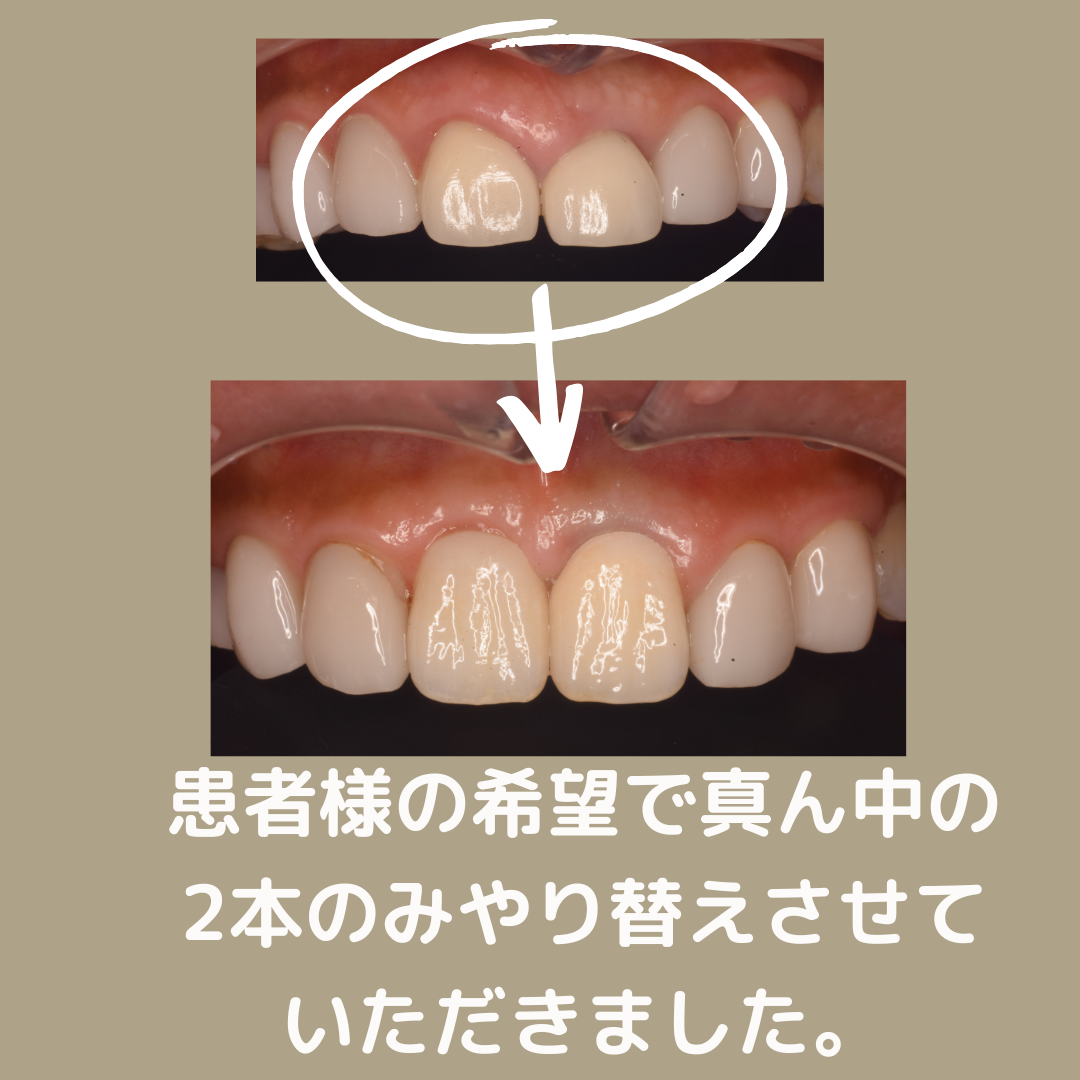 他院でのセラミック治療のやり直し | 和歌山県岩出市の歯科・歯医者