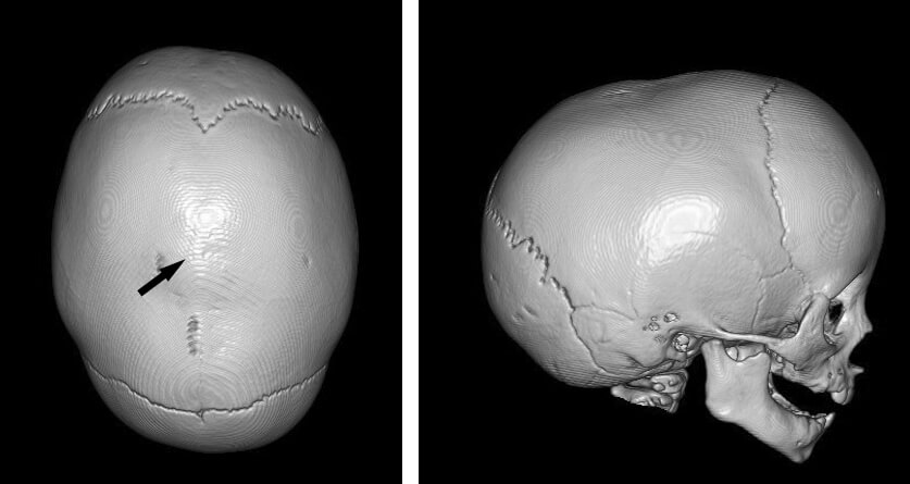 頭蓋縫合早期癒合症｜日本形成外科学会
