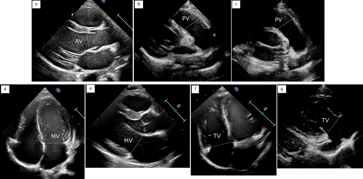 小児および先天性心疾患における心エコーの基本と一般的な計測