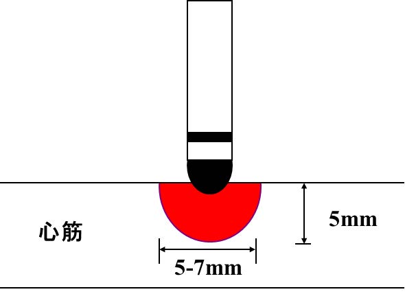 専門診療7 カテーテルアブレーション – 近畿大学医学部循環器内科学