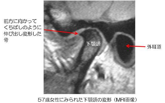 顎関節症の4つの型 | 木野顎関節研究所｜木野顎関節研究所