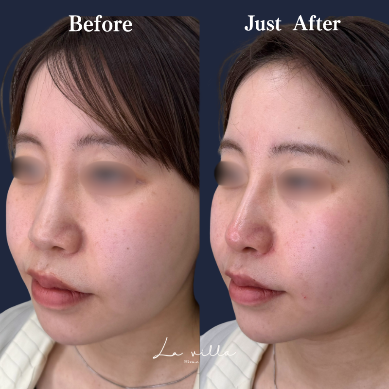 ヒアルロン酸注入｜ La villa Hiroo ラヴィラ広尾-美容外科/美容皮膚科