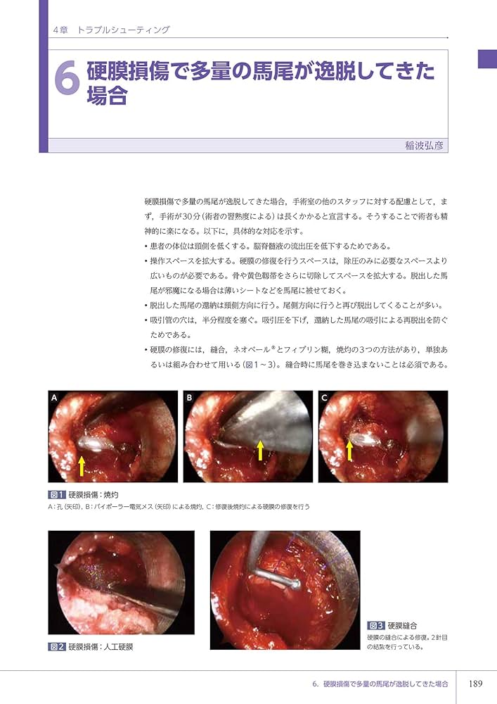 若手脊椎外科医のための内視鏡手術ガイド 岩井グループの技術の今