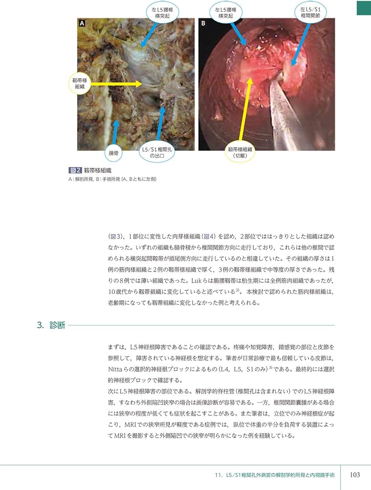 若手脊椎外科医のための内視鏡手術ガイド 岩井グループの技術の今