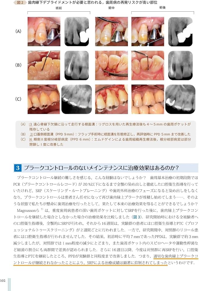 超音波”を攻略せよ ペリオドンタル・デブライドメント: プラス1 | 大野