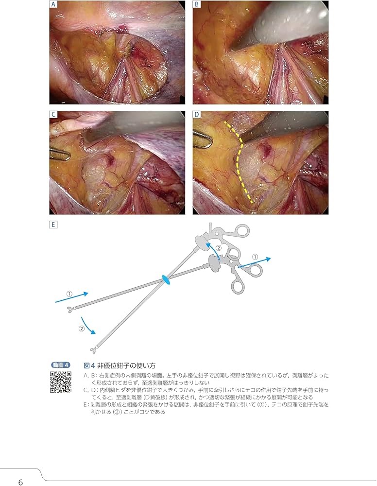 おさえておきたい 腹腔鏡下鼠径部ヘルニア修復術のすべて | 星野明弘