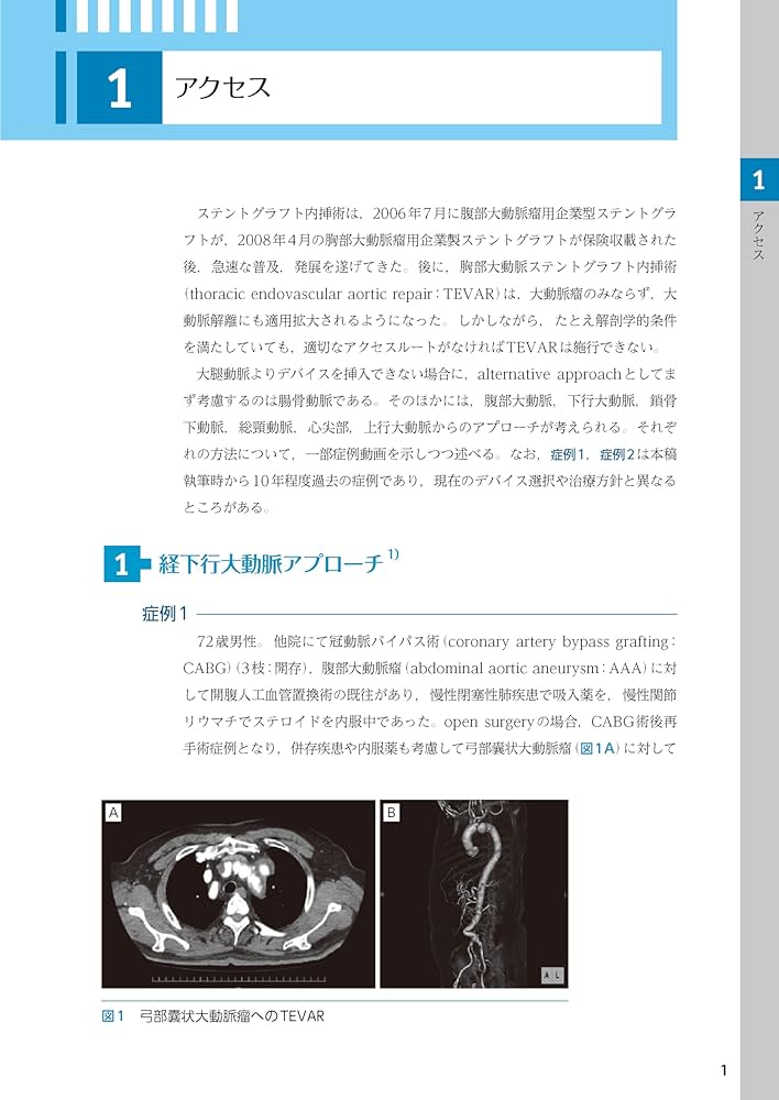 ステントグラフト内挿術マニュアル 胸部編 ─ 動画を含む電子版付