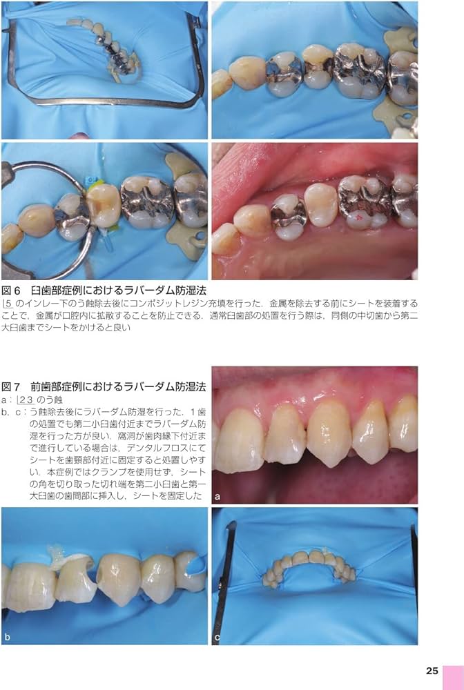 Amazon.co.jp: 歯科臨床まずはここから! う蝕処置: 卒後5年を支える