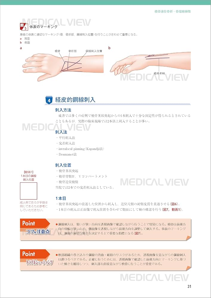 小児の骨折と手術［Web動画付］ (新OS NEXUS) | 大谷 卓也 |本 | 通販